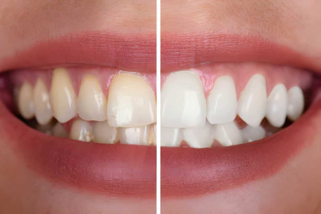 before-and-after-whitening